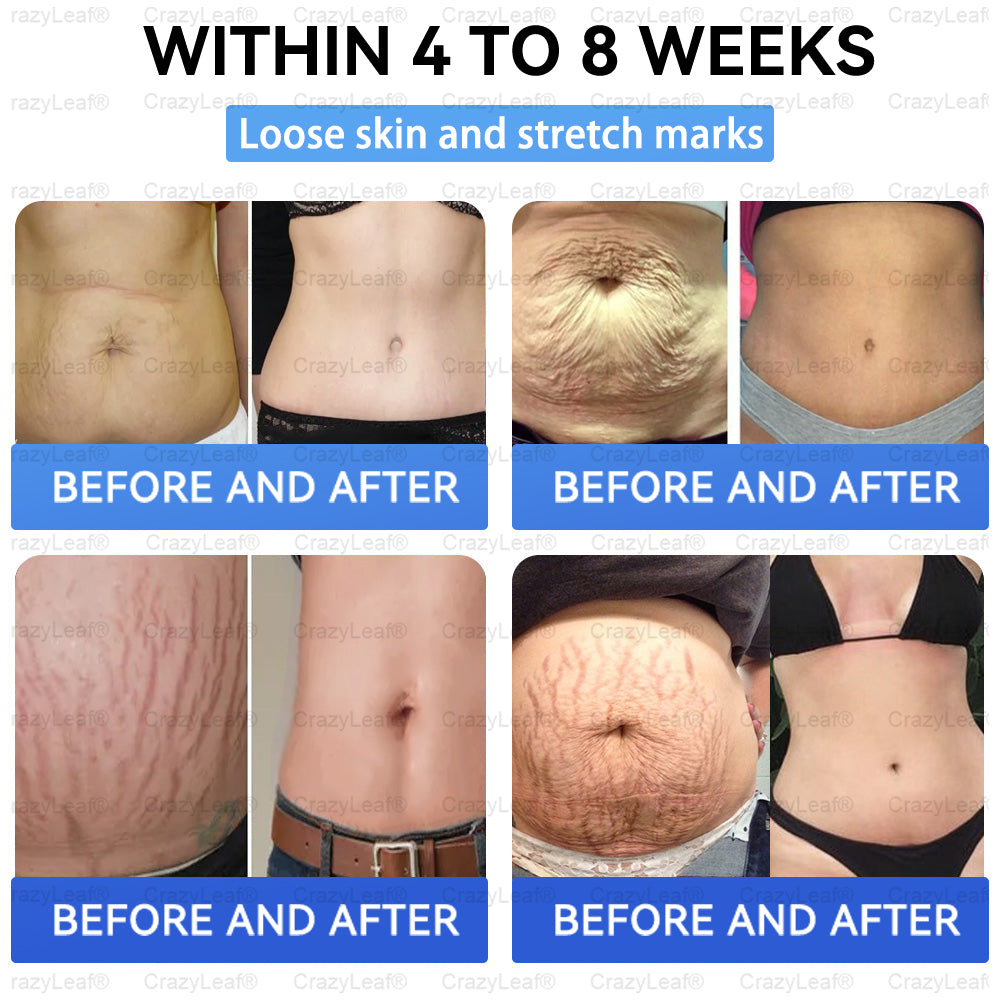 CrazyLeaf® 💙 Nano Microneedle Patch with SMGT-GLP-1, Matrixyl 3000, Botox & Collagen Peptides – Targets: Obesity, Skin Firmness, Cardiovascular Disease, Diabetes, Sleep Apnea, Joint Issues, and More 2