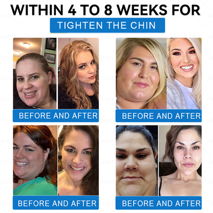 "Last 30 Minutes: Buy One, Get One Free!" CrazyLeaf® SMGT-GLP-1 Nano Microneedle Patch with Collagen & Matrixyl 3000 | Targets: Obesity, Skin Firmness, Cardiovascular Disease, Diabetes, Sleep Apnea, Joint Issues, and More