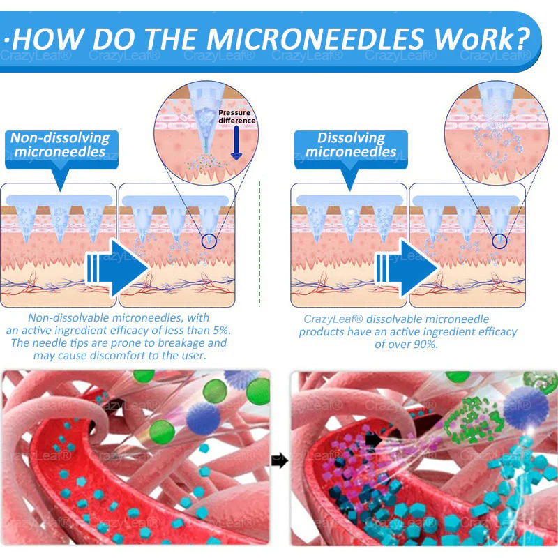 "Last 30 Minutes: Buy One, Get One Free!" CrazyLeaf® SMGT-GLP-1 Nano Microneedle Patch with Collagen & Matrixyl 3000 | Targets: Obesity, Skin Firmness, Cardiovascular Disease, Diabetes, Sleep Apnea, Joint Issues, and More